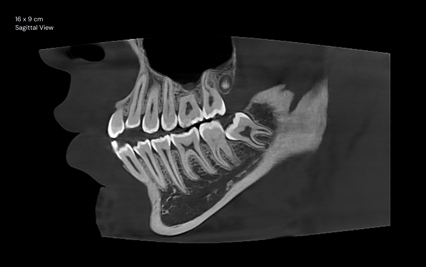 16 x 9 cm Sagittal View